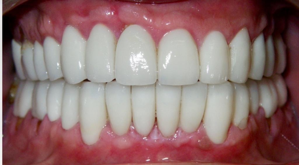 Patient teeth after treatment — Case 1