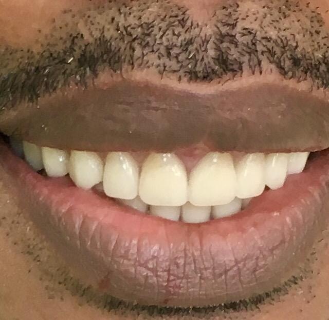 Patient teeth after treatment — Case 2