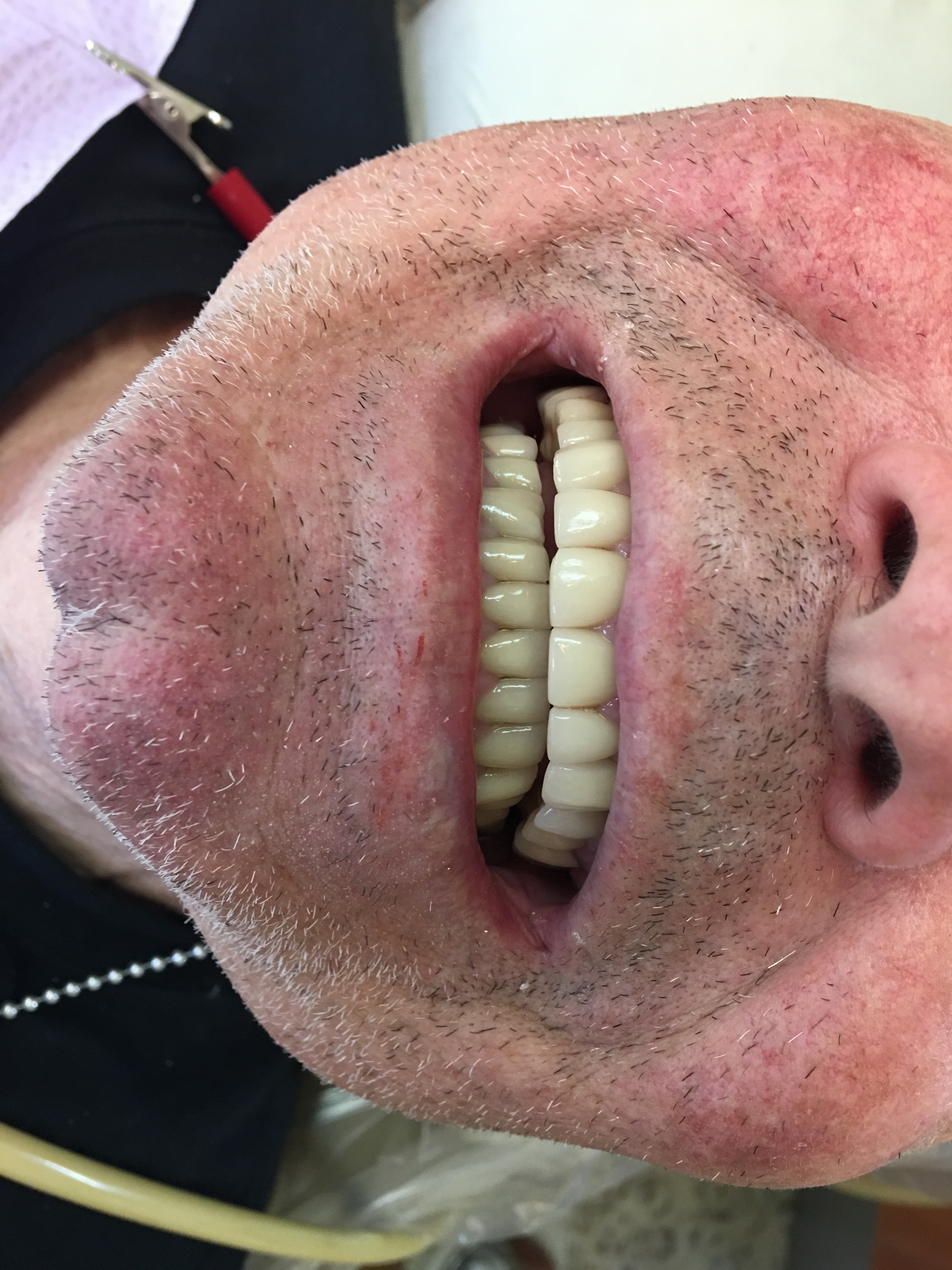 Patient teeth after treatment — Case 3