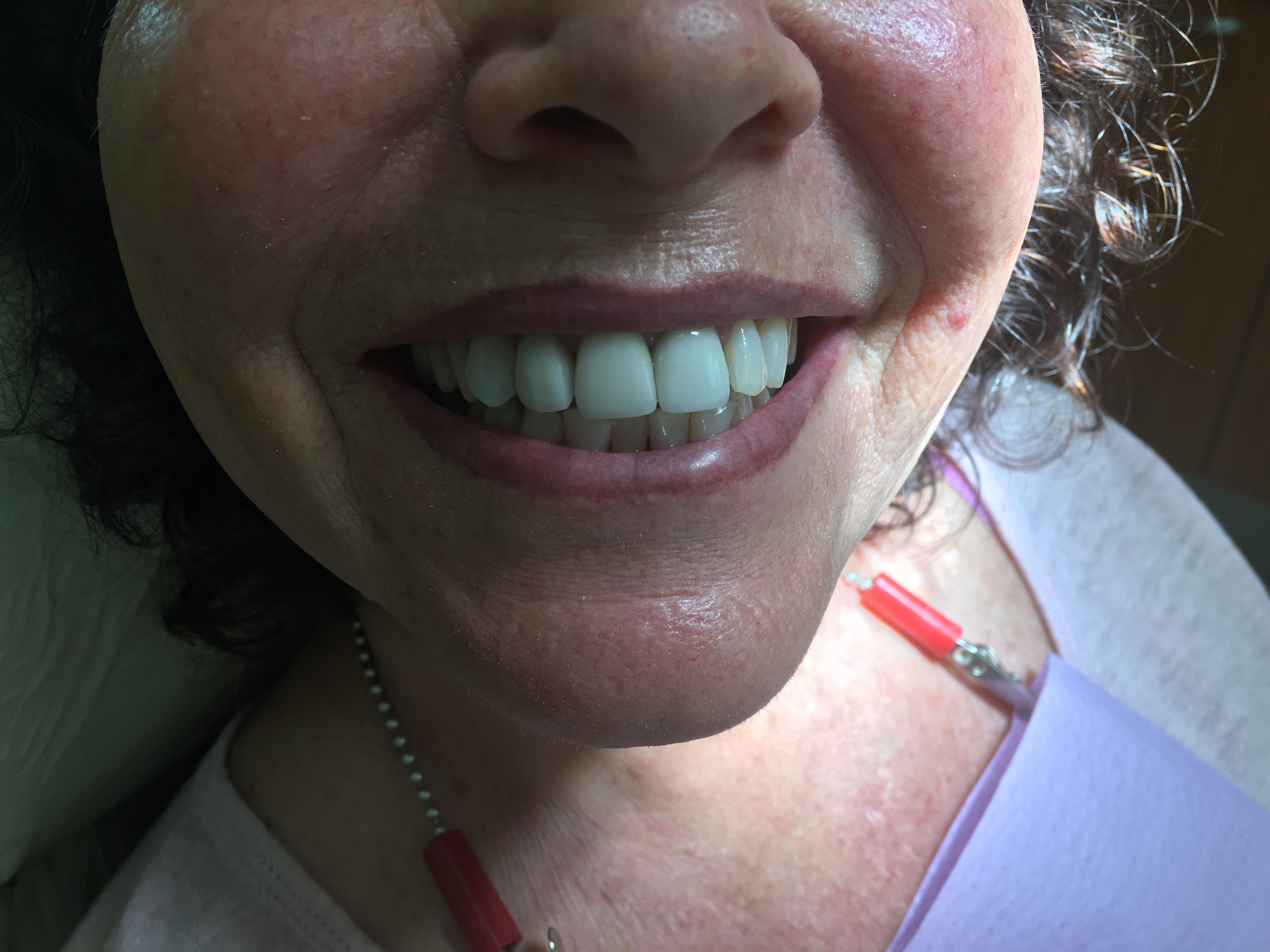 Patient teeth after treatment — Case 5