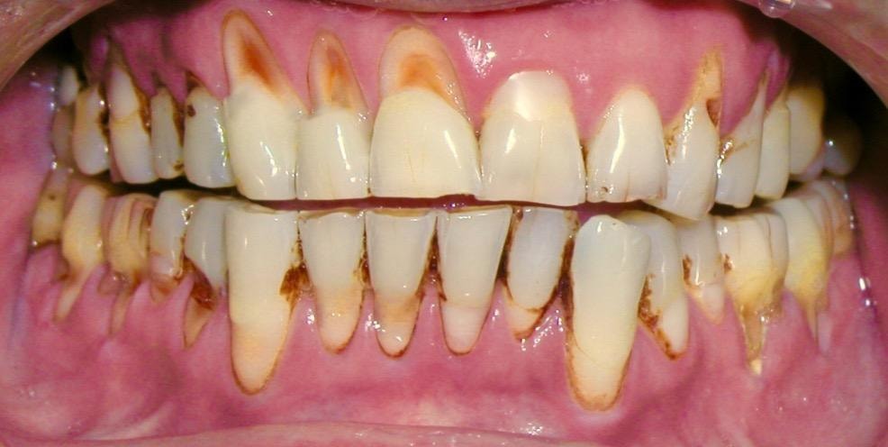 Patient teeth before treatment — Case 1