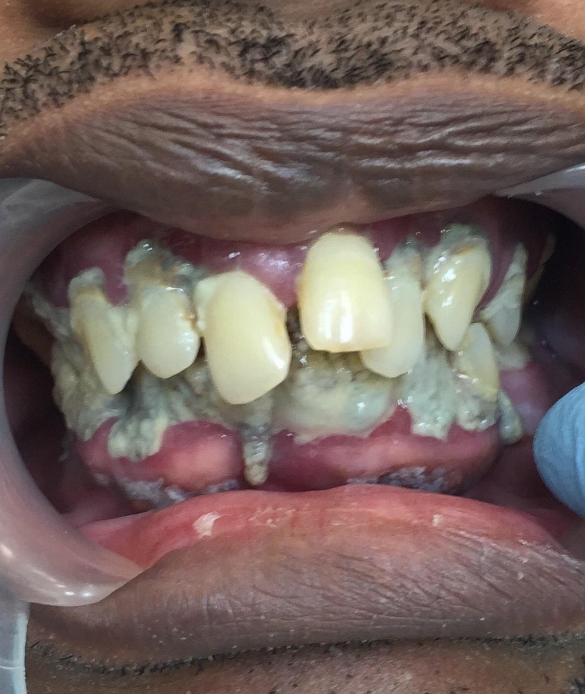 Patient teeth before treatment — Case 2