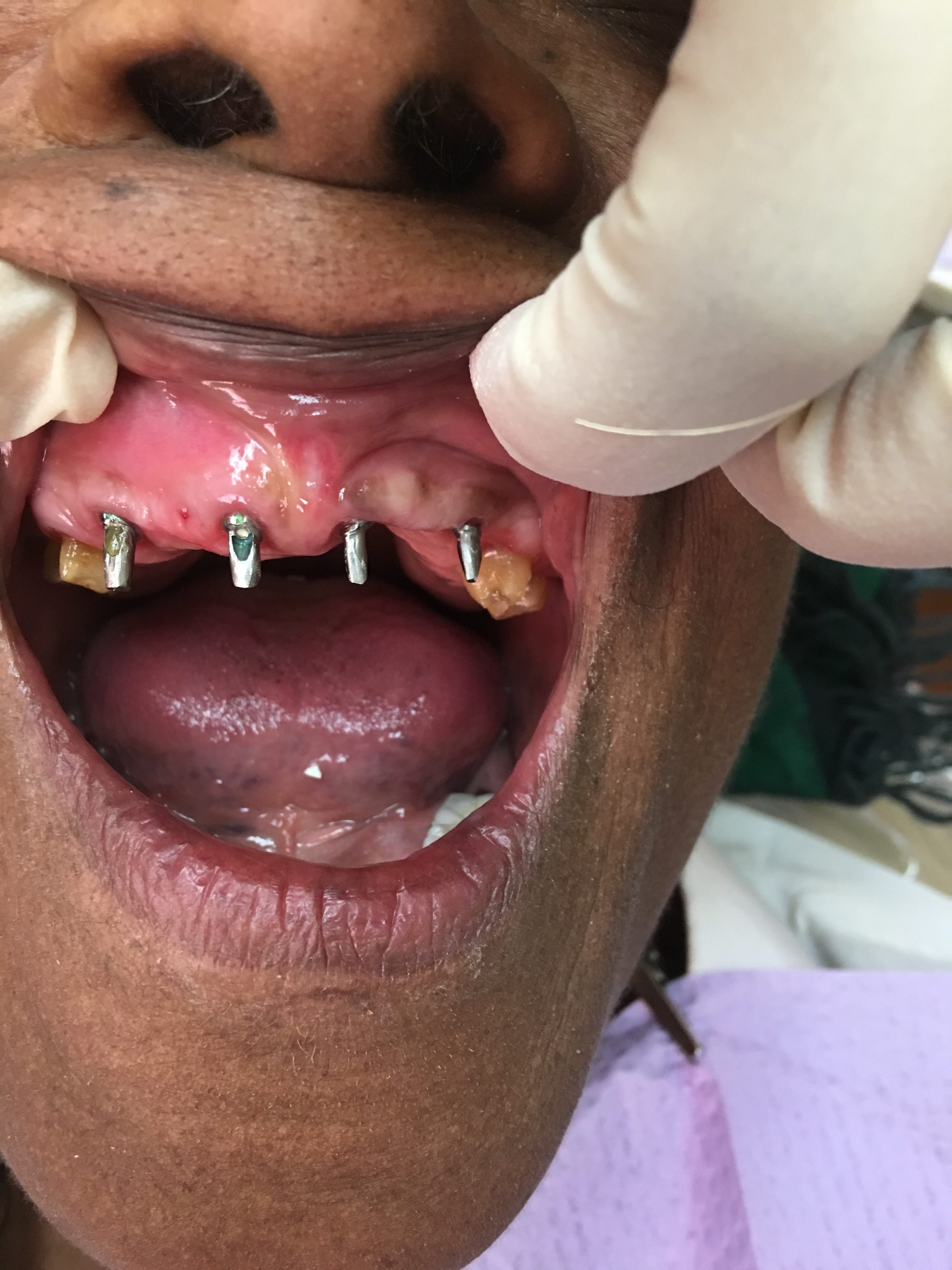 Patient teeth before treatment — Case 4