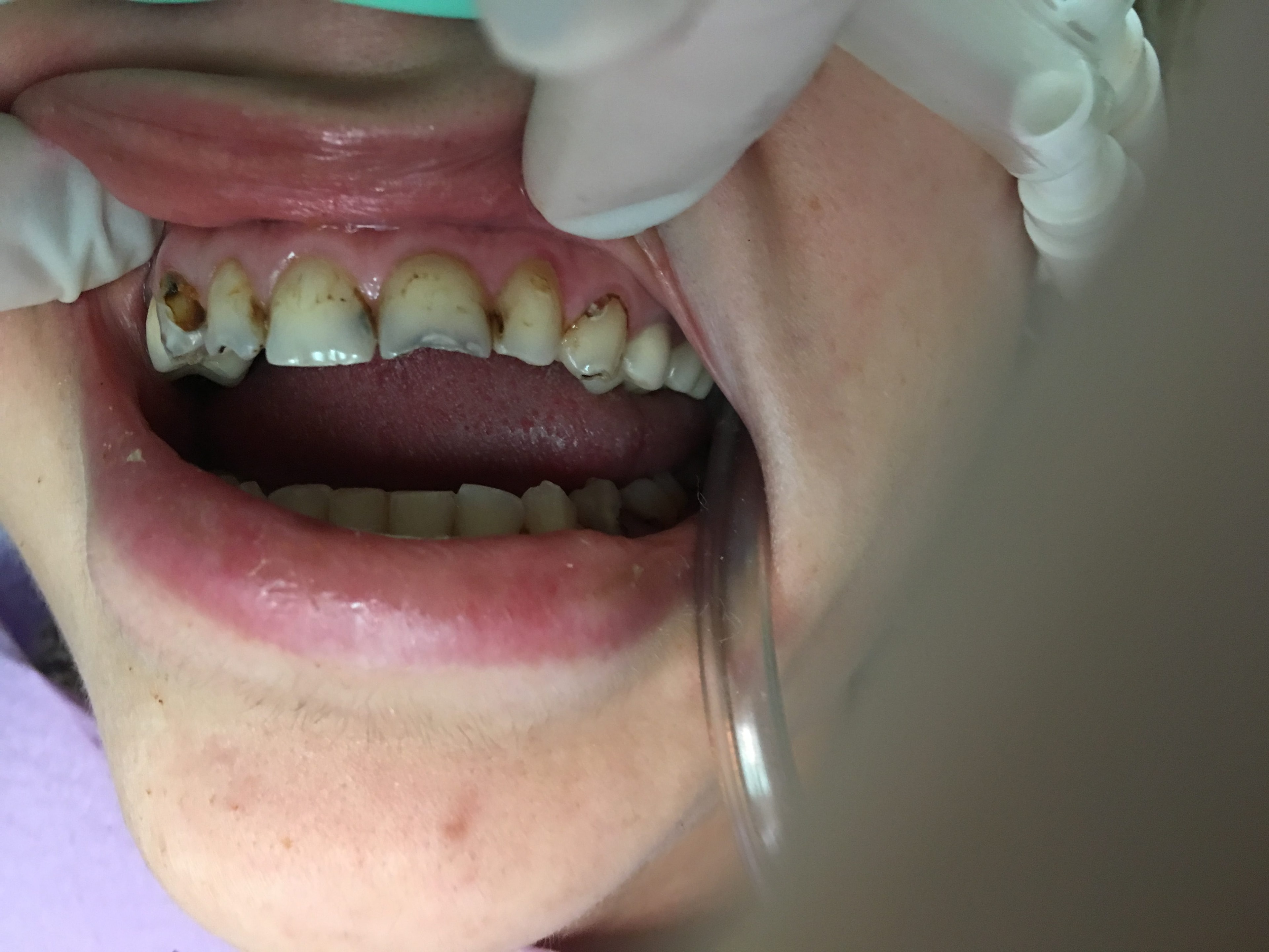Patient teeth before treatment — Case 5